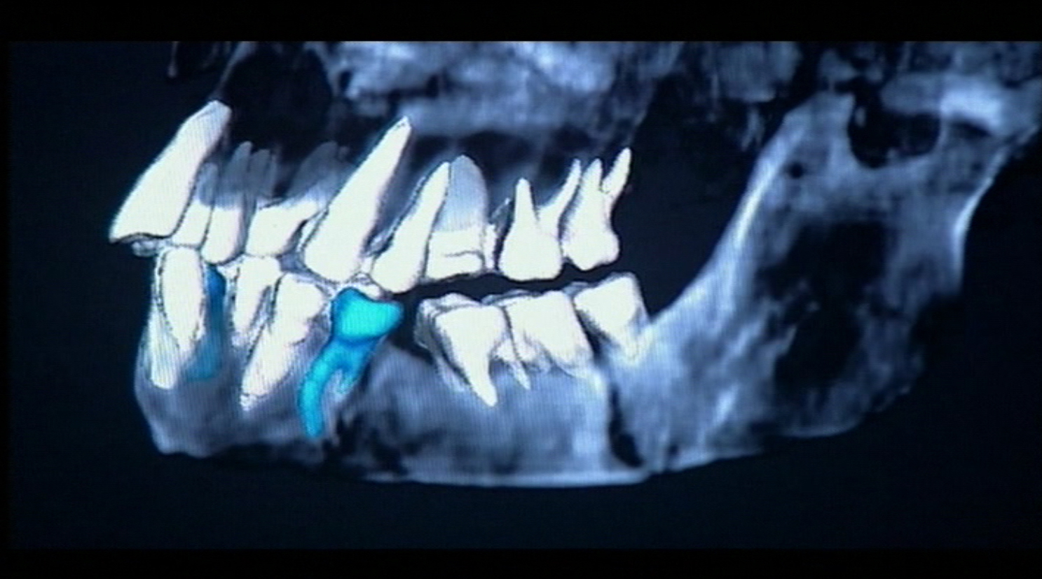 BBC horizon Homo floresiensis LB1 ct reconstruction
